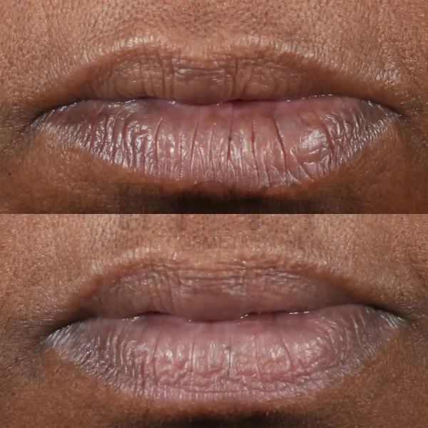 Perricone MD Cold Plasma Plus+ Lip Therapy Moisturizing Lip Balm, 4.2 g